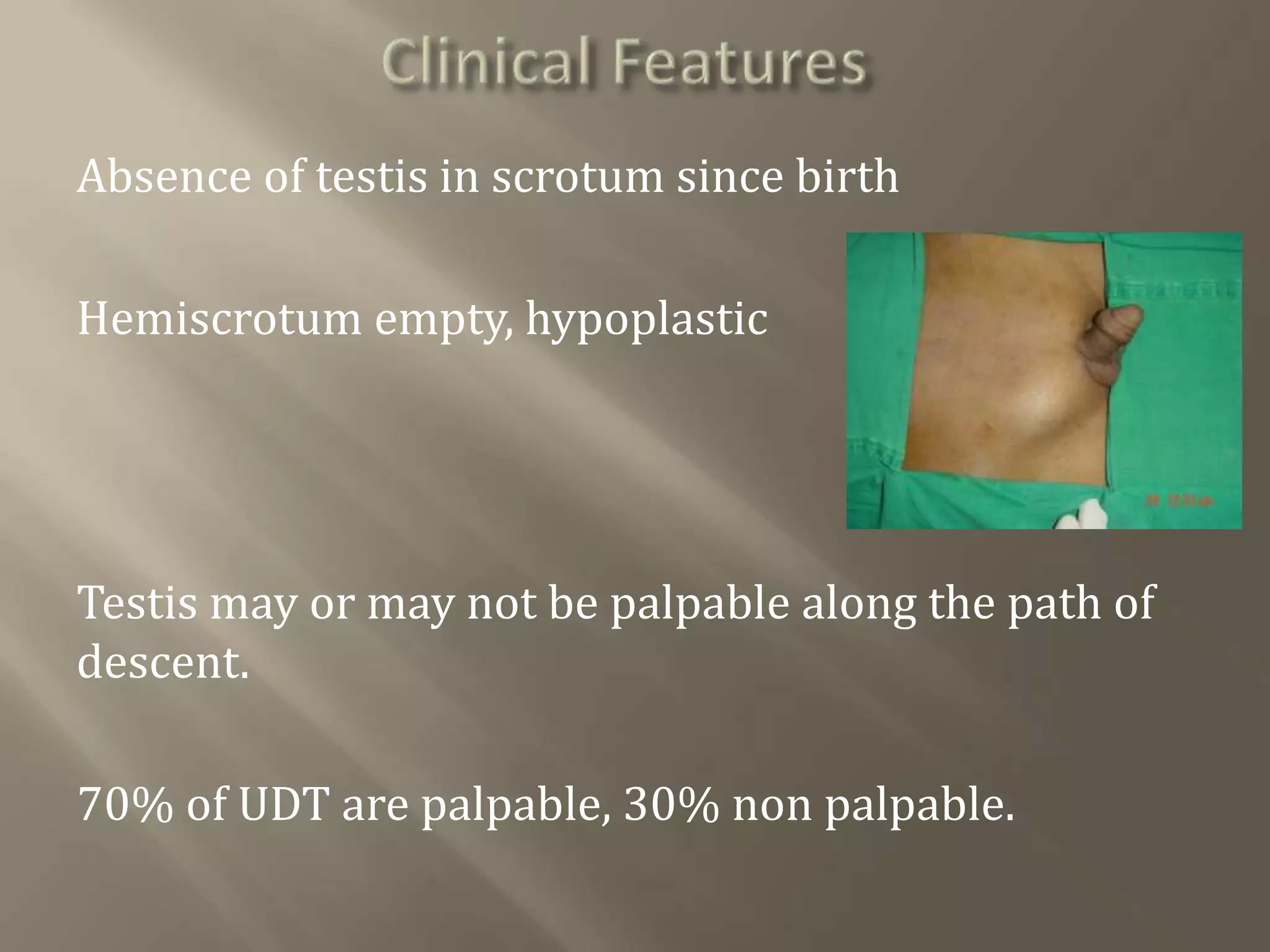 Absence of testis in scrotum since birth
Hemiscrotum empty, hypoplastic
Testis may or may not be palpable along the path of
descent.
70% of UDT are palpable, 30% non palpable.
 