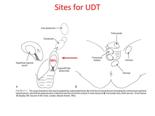 Sites for UDT
60%
 