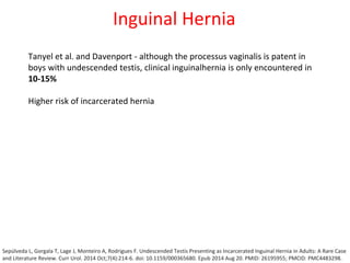 Inguinal Hernia
Tanyel et al. and Davenport - although the processus vaginalis is patent in
boys with undescended testis, clinical inguinalhernia is only encountered in
10-15%
Higher risk of incarcerated hernia
Sepúlveda L, Gorgala T, Lage J, Monteiro A, Rodrigues F. Undescended Testis Presenting as Incarcerated Inguinal Hernia in Adults: A Rare Case
and Literature Review. Curr Urol. 2014 Oct;7(4):214-6. doi: 10.1159/000365680. Epub 2014 Aug 20. PMID: 26195955; PMCID: PMC4483298.
 