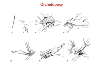 35
Orchidopexy
 