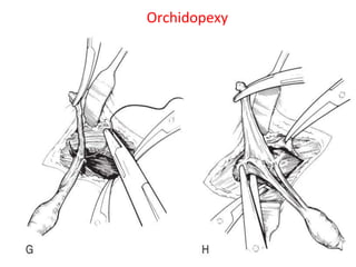 36
Orchidopexy
 
