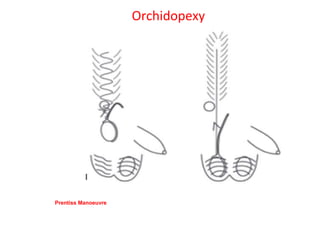 Orchidopexy
Prentiss Manoeuvre
 