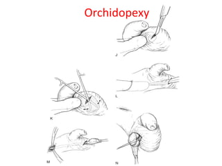 Orchidopexy
 
