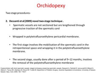 Two stage procedures-
2. Dessanti etal(2009) novel two-stage technique .
• Spermatic vessels are not sectioned but are lengthened through
progressive traction of the spermatic cord
• Wrapped in polytetrafluoroethylene pericardial membrane.
• The first stage involves the mobilisation of the spermatic cord in the
retroperitoneal space and wrapping it in the polytetrafluoroethylene
membrane.
• The second stage, usually done after a period of 9–12 months, involves
the removal of the polytetrafluoroethylene membrane
Orchidopexy
Cryptorchidism with short spermatic vessels: staged orchiopexy preserving spermatic vessels ;Dessanti A, Falchetti D, Iannuccelli M, Milianti S,
Altana C, Tanca AR, Ubertazzi M, Strusi GP, Fusillo M ;Department of Pediatric Surgery, Azienda Ospedaliero-Universitaria, University of Sassari,
Sassari, Italy J Urol. 2009; 182: 1163-7
 