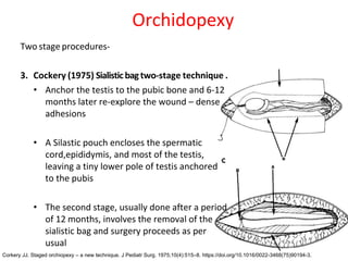 Two stage procedures-
3. Cockery (1975) Sialisticbagtwo-stage technique .
• Anchor the testis to the pubic bone and 6-12
months later re-explore the wound – dense
adhesions
• A Silastic pouch encloses the spermatic
cord,epididymis, and most of the testis,
leaving a tiny lower pole of testis anchored
to the pubis
• The second stage, usually done after a period
of 12 months, involves the removal of the
sialistic bag and surgery proceeds as per
usual
Orchidopexy
Corkery JJ. Staged orchiopexy – a new technique. J Pediatr Surg. 1975;10(4):515–8. https://doi.org/10.1016/0022-3468(75)90194-3.
 