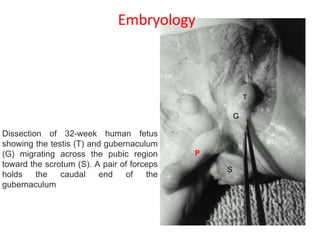 P
Dissection of 32-week human fetus
showing the testis (T) and gubernaculum
(G) migrating across the pubic region
toward the scrotum (S). A pair of forceps
holds the caudal end of the
gubernaculum
Embryology
 