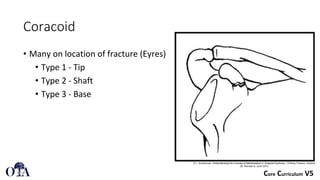 Scapula Fractures classification and manegment | PDF