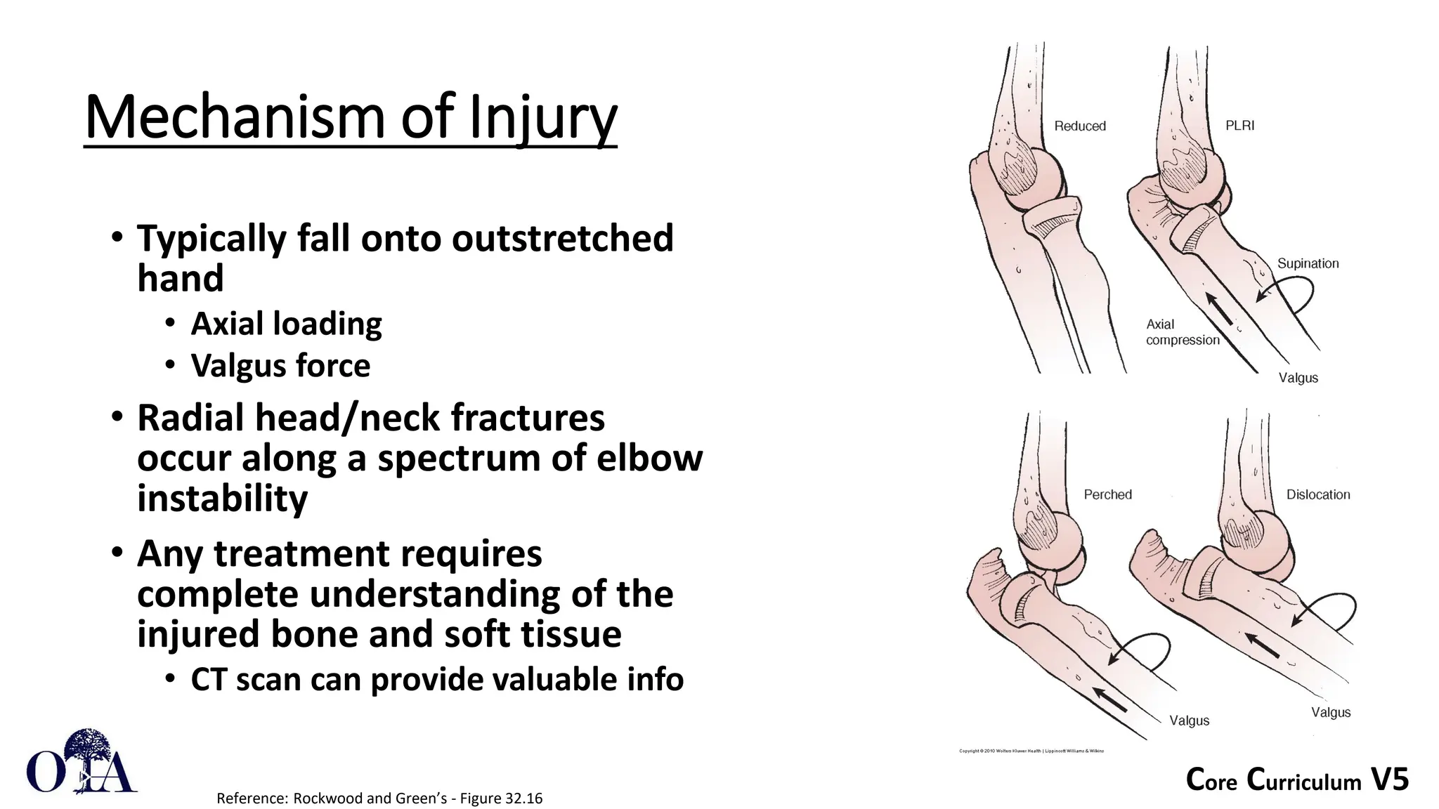 Core Curriculum V5
Mechanism of Injury
• Typically fall onto outstretched
hand
• Axial loading
• Valgus force
• Radial head/neck fractures
occur along a spectrum of elbow
instability
• Any treatment requires
complete understanding of the
injured bone and soft tissue
• CT scan can provide valuable info
Reference: Rockwood and Green’s - Figure 32.16
 