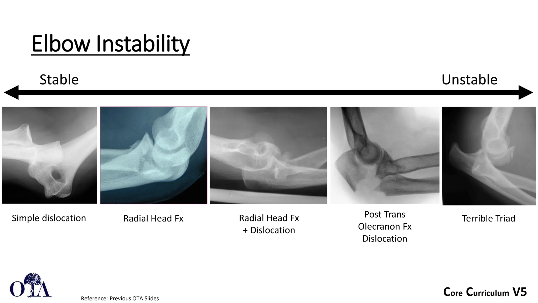 Core Curriculum V5
Elbow Instability
Stable Unstable
Simple dislocation Radial Head Fx Radial Head Fx
+ Dislocation
Post Trans
Olecranon Fx
Dislocation
Terrible Triad
Reference: Previous OTA Slides
 
