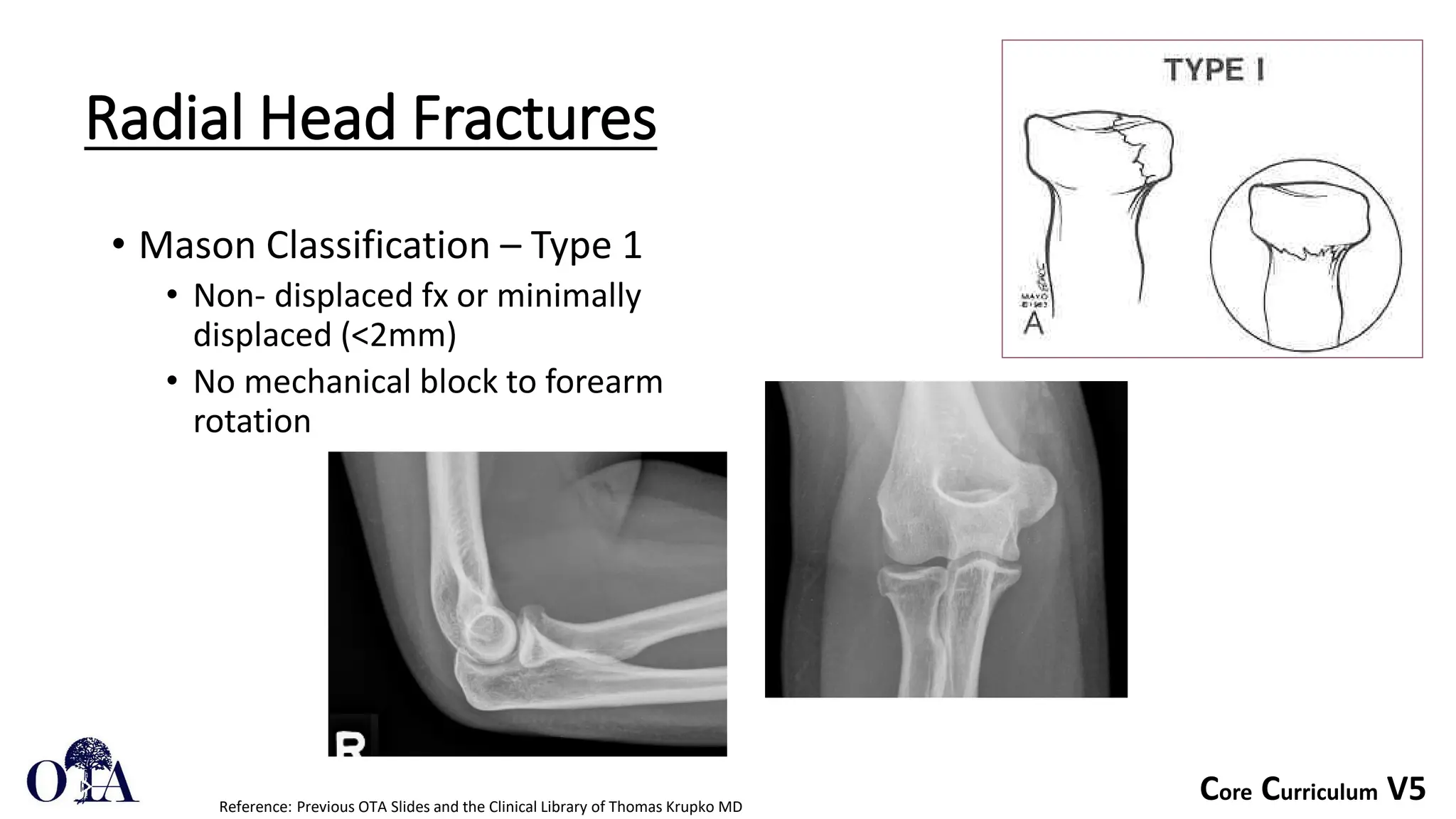 Core Curriculum V5
Radial Head Fractures
• Mason Classification – Type 1
• Non- displaced fx or minimally
displaced (<2mm)
• No mechanical block to forearm
rotation
Reference: Previous OTA Slides and the Clinical Library of Thomas Krupko MD
 