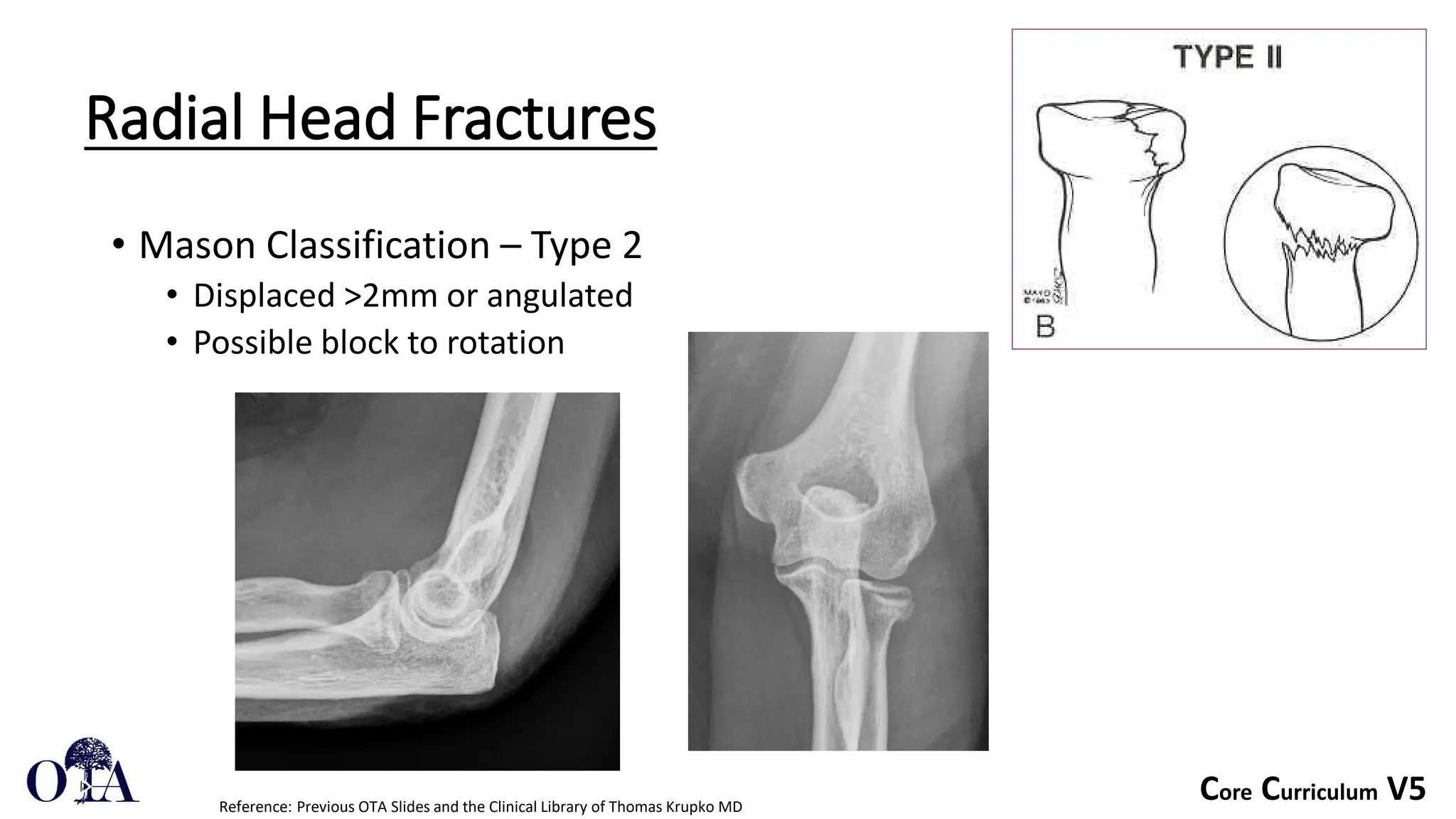 Core Curriculum V5
Radial Head Fractures
• Mason Classification – Type 2
• Displaced >2mm or angulated
• Possible block to rotation
Reference: Previous OTA Slides and the Clinical Library of Thomas Krupko MD
 