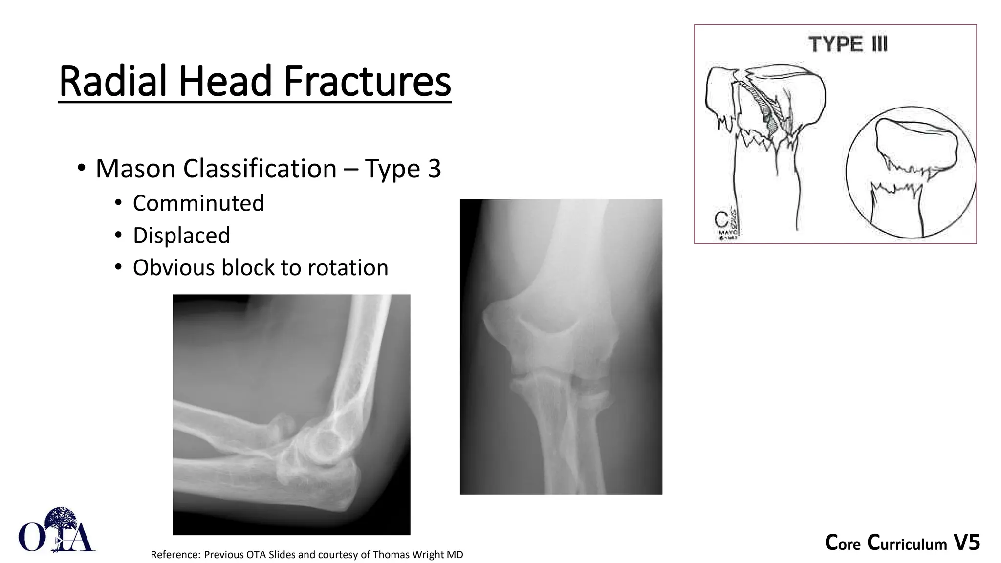 Core Curriculum V5
Radial Head Fractures
• Mason Classification – Type 3
• Comminuted
• Displaced
• Obvious block to rotation
Reference: Previous OTA Slides and courtesy of Thomas Wright MD
 
