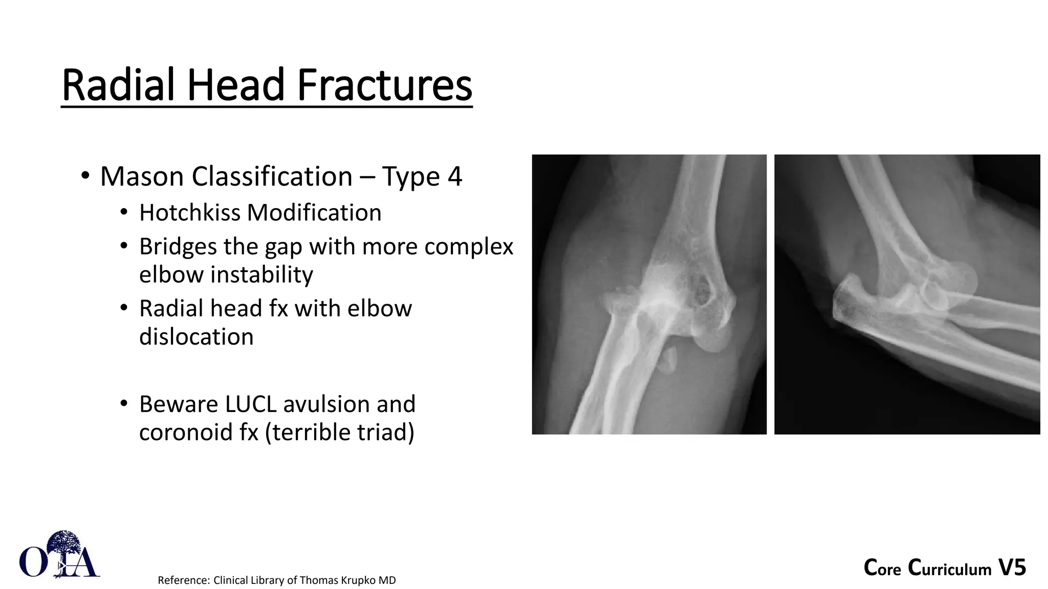 Core Curriculum V5
Radial Head Fractures
• Mason Classification – Type 4
• Hotchkiss Modification
• Bridges the gap with more complex
elbow instability
• Radial head fx with elbow
dislocation
• Beware LUCL avulsion and
coronoid fx (terrible triad)
Reference: Clinical Library of Thomas Krupko MD
 