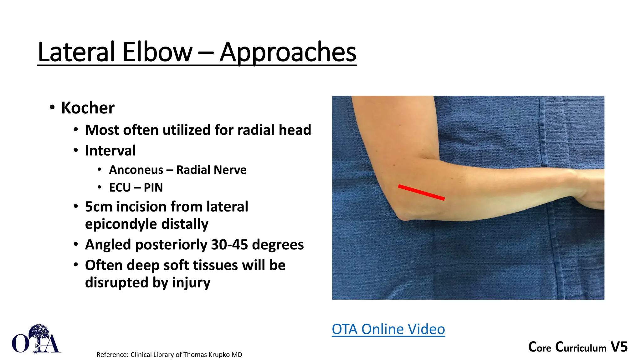 Core Curriculum V5
Lateral Elbow – Approaches
• Kocher
• Most often utilized for radial head
• Interval
• Anconeus – Radial Nerve
• ECU – PIN
• 5cm incision from lateral
epicondyle distally
• Angled posteriorly 30-45 degrees
• Often deep soft tissues will be
disrupted by injury
Reference: Clinical Library of Thomas Krupko MD
OTA Online Video
 