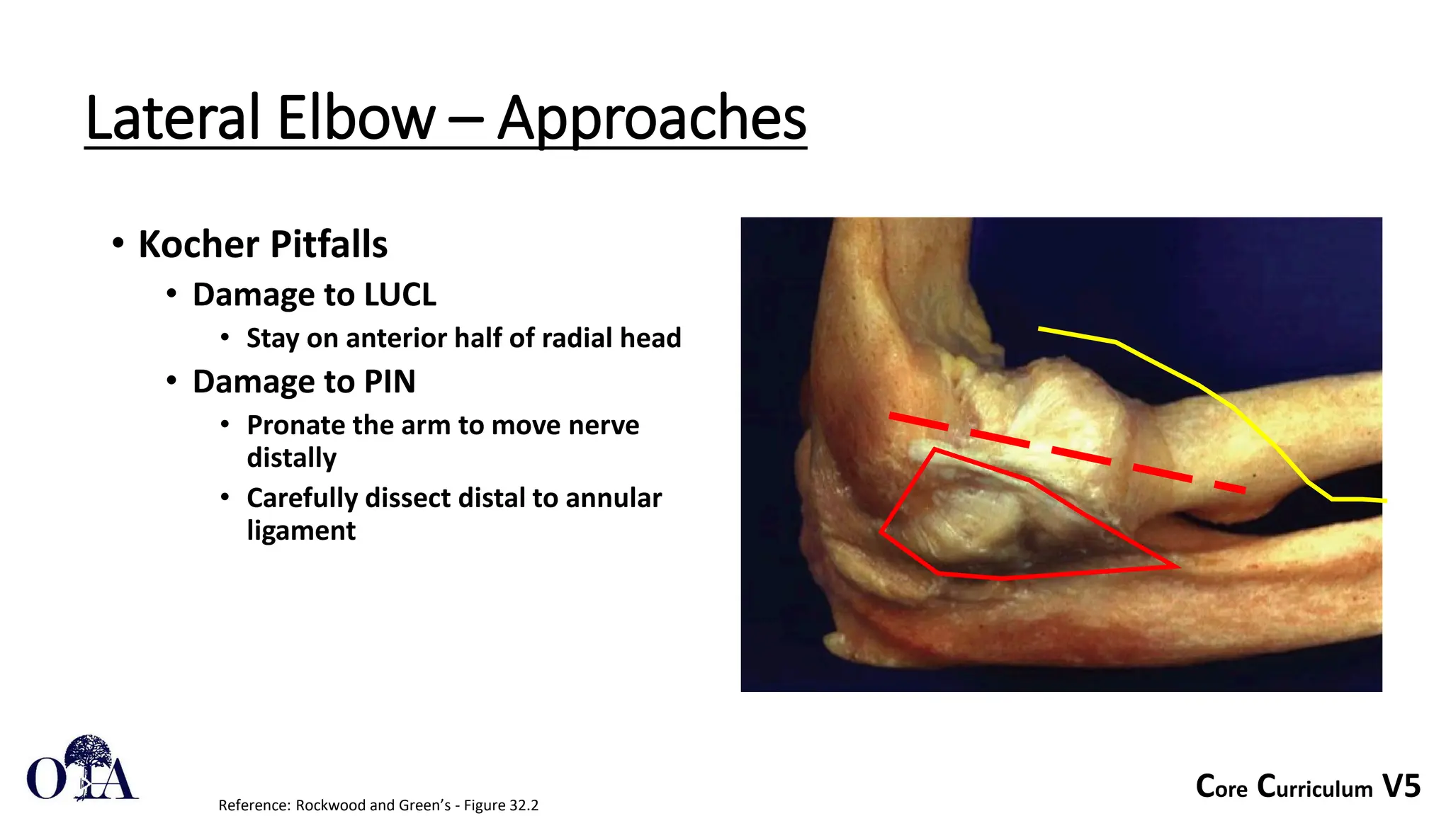 Core Curriculum V5
Lateral Elbow – Approaches
• Kocher Pitfalls
• Damage to LUCL
• Stay on anterior half of radial head
• Damage to PIN
• Pronate the arm to move nerve
distally
• Carefully dissect distal to annular
ligament
Reference: Rockwood and Green’s - Figure 32.2
 