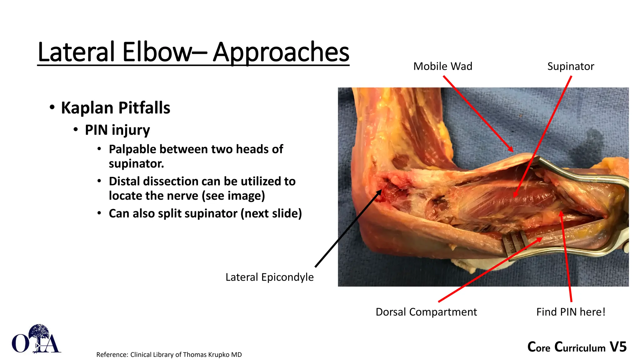 Core Curriculum V5
Lateral Elbow– Approaches
• Kaplan Pitfalls
• PIN injury
• Palpable between two heads of
supinator.
• Distal dissection can be utilized to
locate the nerve (see image)
• Can also split supinator (next slide)
Reference: Clinical Library of Thomas Krupko MD
Lateral Epicondyle
Mobile Wad
Dorsal Compartment
Supinator
Find PIN here!
 