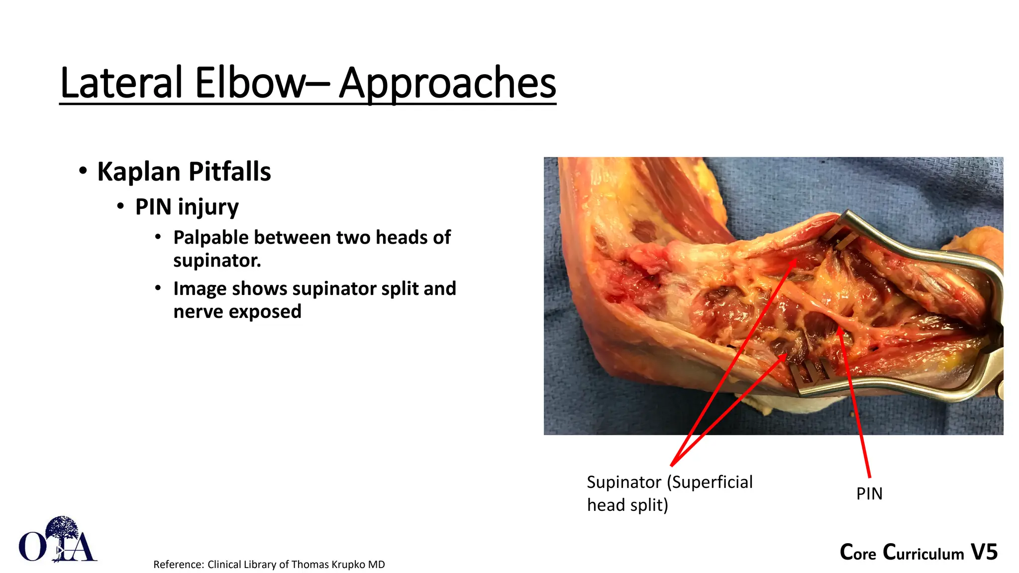 Core Curriculum V5
Lateral Elbow– Approaches
• Kaplan Pitfalls
• PIN injury
• Palpable between two heads of
supinator.
• Image shows supinator split and
nerve exposed
Reference: Clinical Library of Thomas Krupko MD
PIN
Supinator (Superficial
head split)
 
