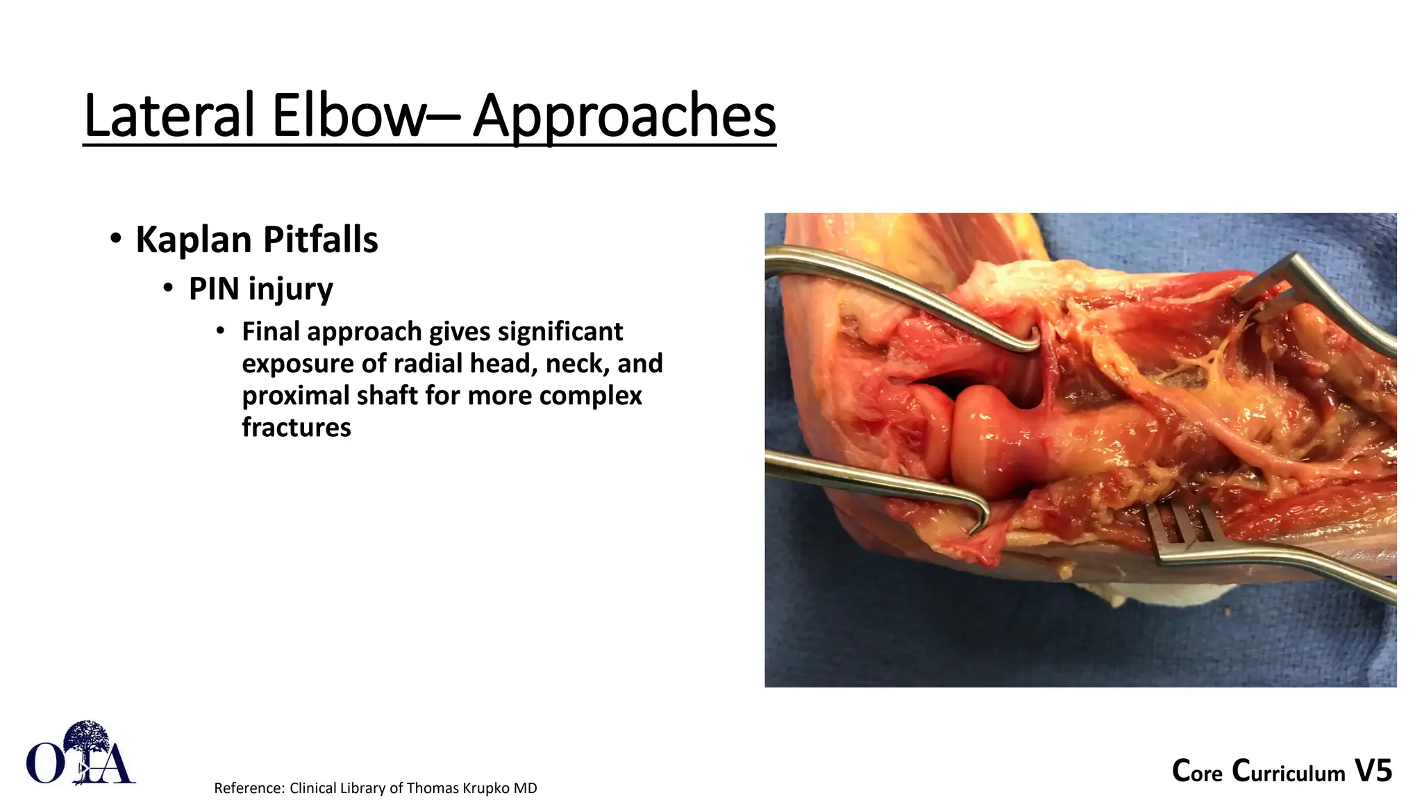 Core Curriculum V5
Lateral Elbow– Approaches
• Kaplan Pitfalls
• PIN injury
• Final approach gives significant
exposure of radial head, neck, and
proximal shaft for more complex
fractures
Reference: Clinical Library of Thomas Krupko MD
 