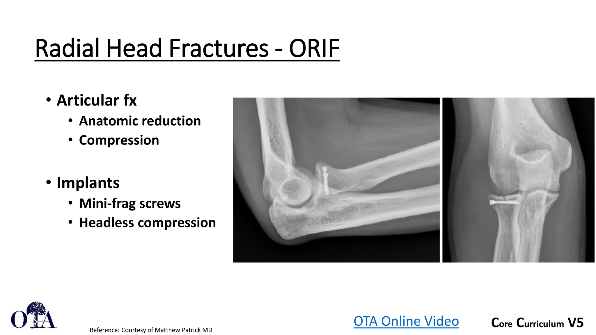 Core Curriculum V5
Radial Head Fractures - ORIF
• Articular fx
• Anatomic reduction
• Compression
• Implants
• Mini-frag screws
• Headless compression
OTA Online Video
Reference: Courtesy of Matthew Patrick MD
 