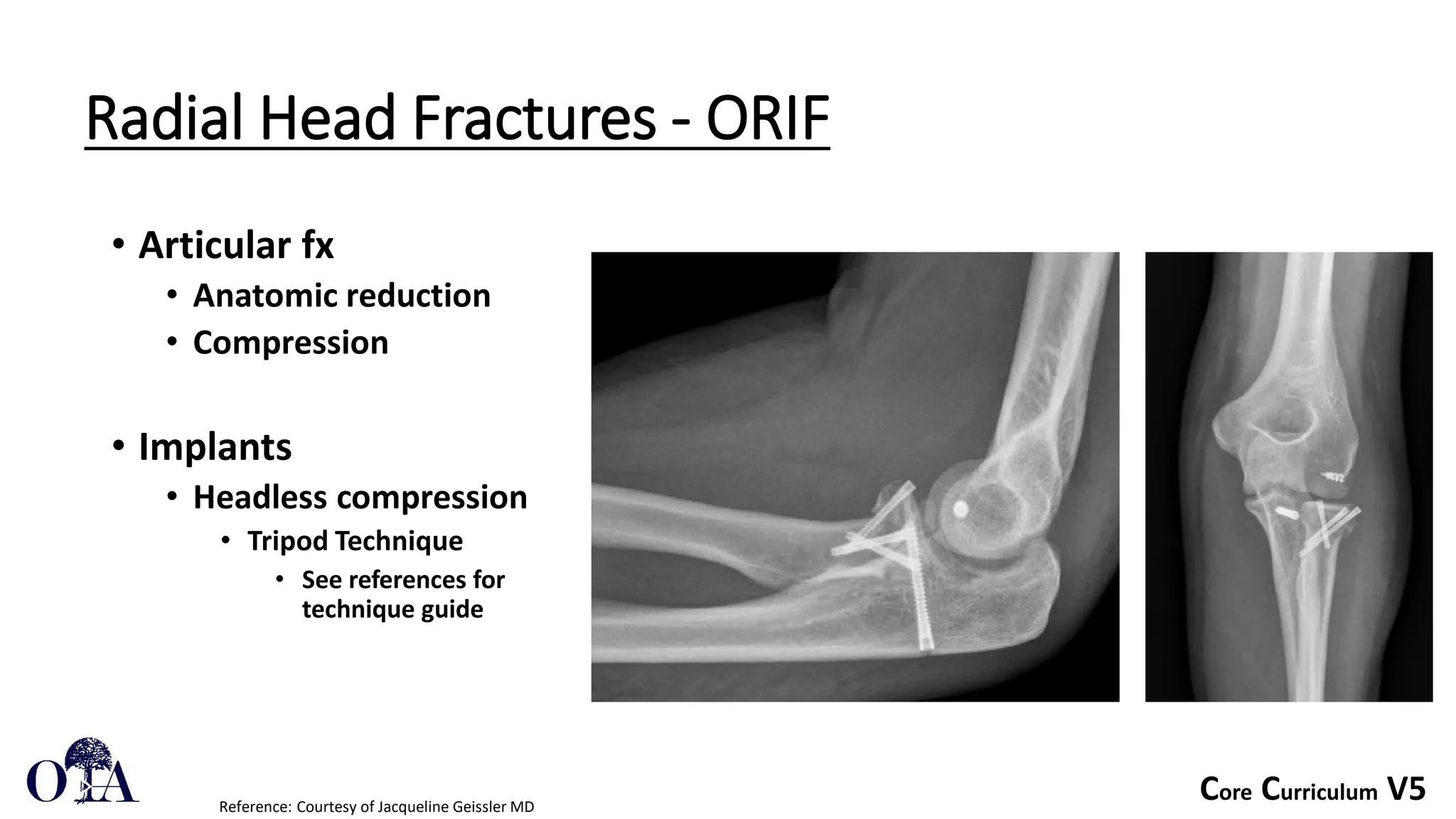 Core Curriculum V5
Radial Head Fractures - ORIF
• Articular fx
• Anatomic reduction
• Compression
• Implants
• Headless compression
• Tripod Technique
• See references for
technique guide
Reference: Courtesy of Jacqueline Geissler MD
 