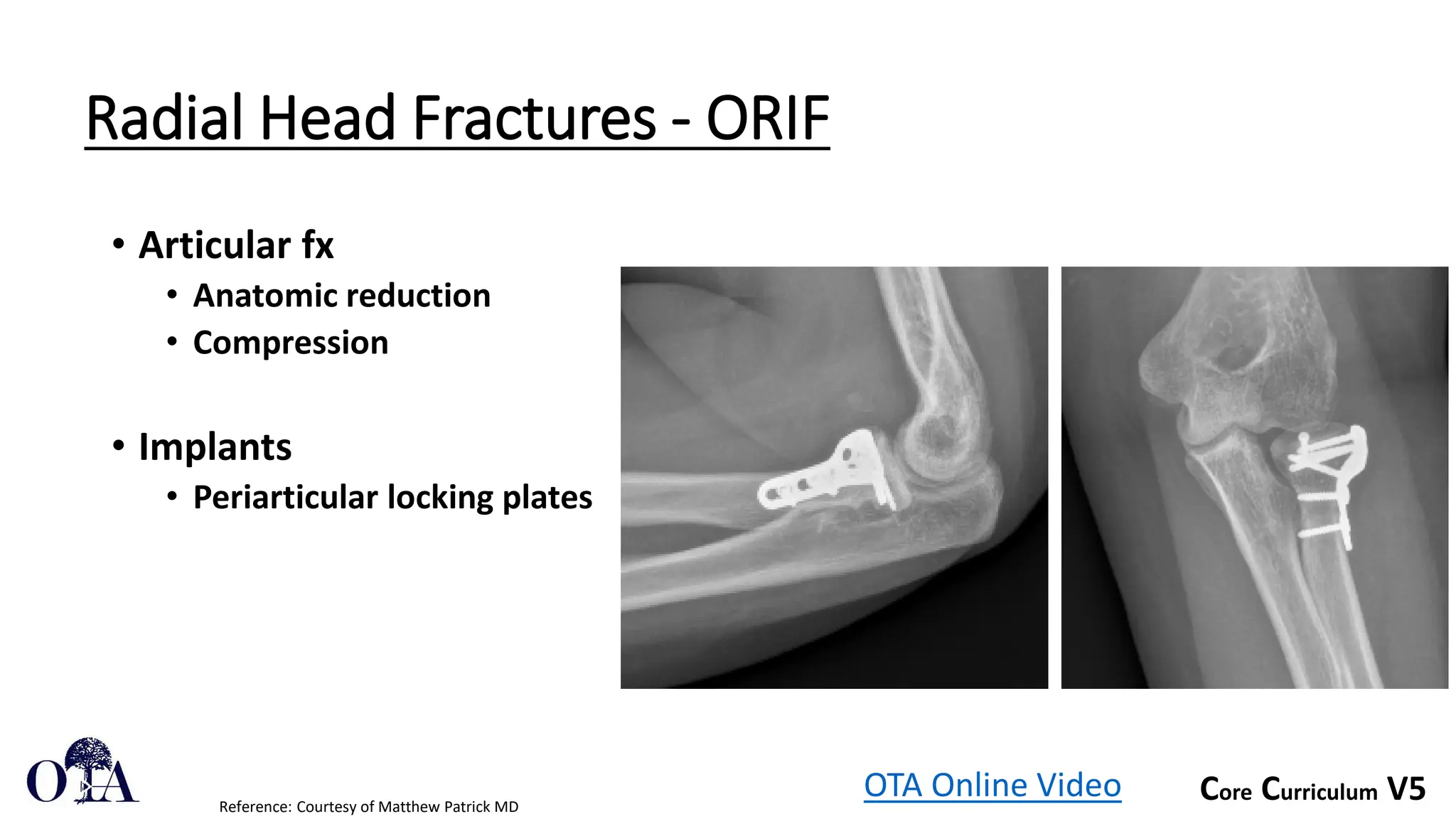 Core Curriculum V5
Radial Head Fractures - ORIF
• Articular fx
• Anatomic reduction
• Compression
• Implants
• Periarticular locking plates
OTA Online Video
Reference: Courtesy of Matthew Patrick MD
 