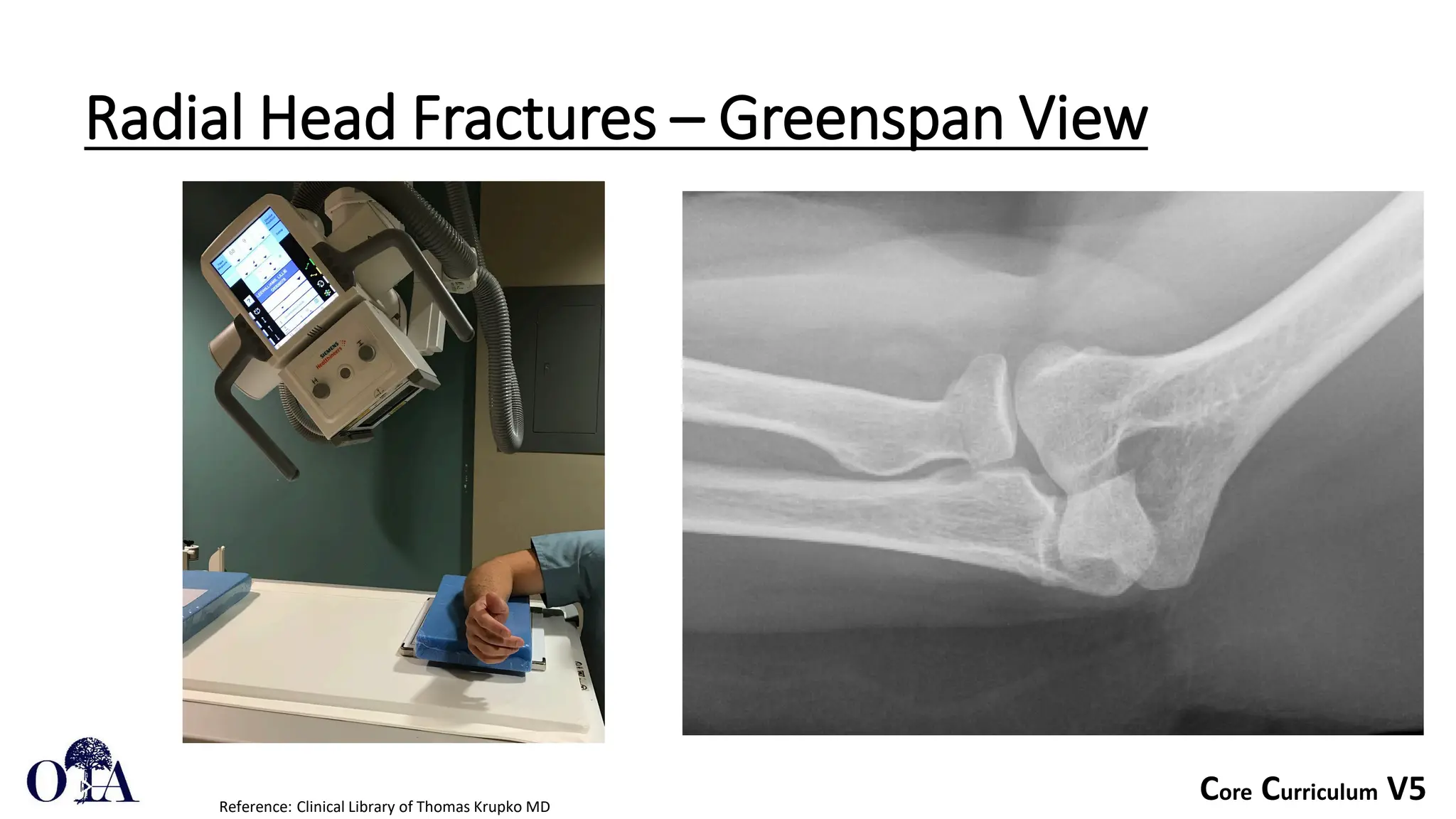 Core Curriculum V5
Radial Head Fractures – Greenspan View
Reference: Clinical Library of Thomas Krupko MD
 