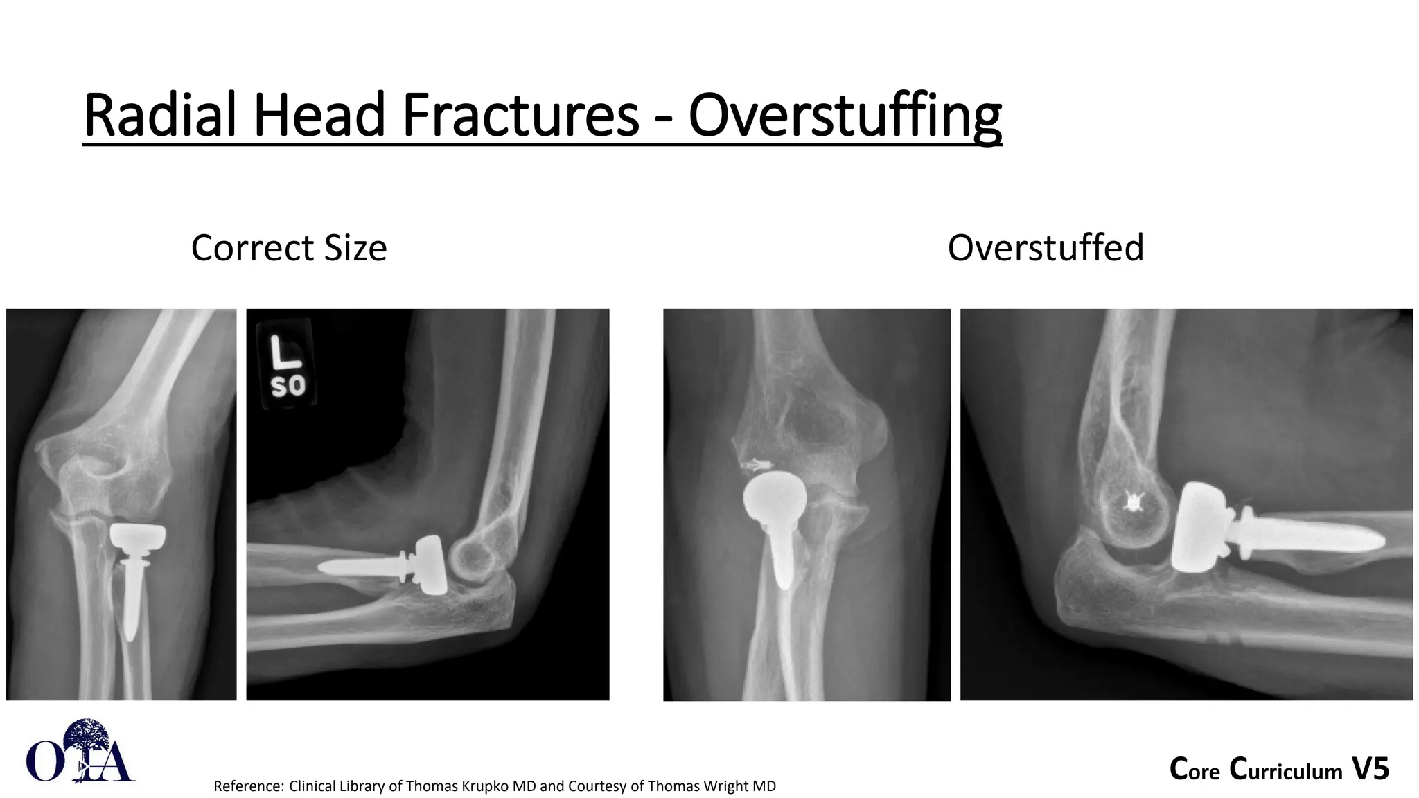 Core Curriculum V5
Radial Head Fractures - Overstuffing
Reference: Clinical Library of Thomas Krupko MD and Courtesy of Thomas Wright MD
Correct Size Overstuffed
 