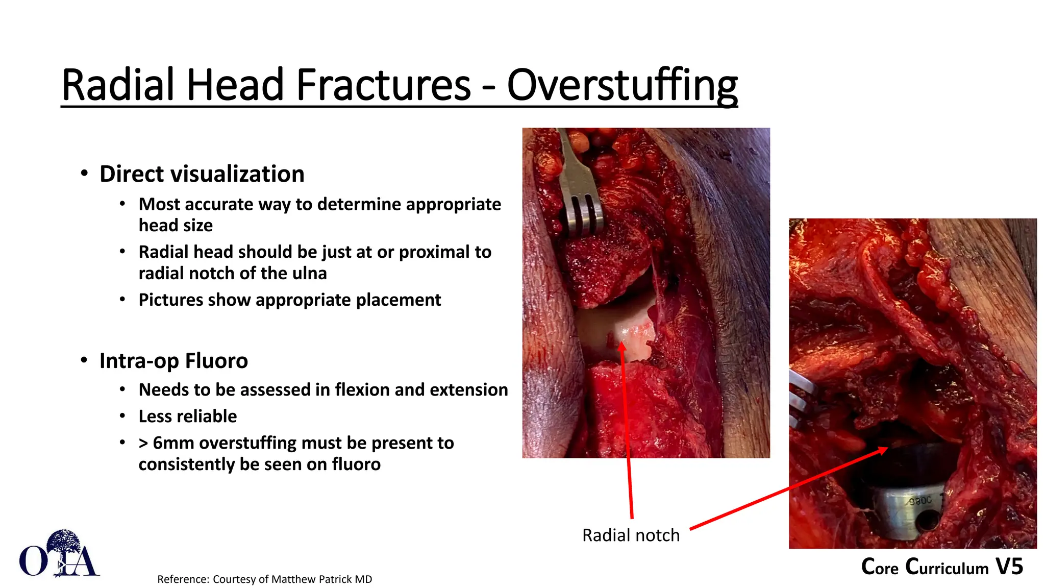 Core Curriculum V5
Radial Head Fractures - Overstuffing
• Direct visualization
• Most accurate way to determine appropriate
head size
• Radial head should be just at or proximal to
radial notch of the ulna
• Pictures show appropriate placement
• Intra-op Fluoro
• Needs to be assessed in flexion and extension
• Less reliable
• > 6mm overstuffing must be present to
consistently be seen on fluoro
Reference: Courtesy of Matthew Patrick MD
Radial notch
 