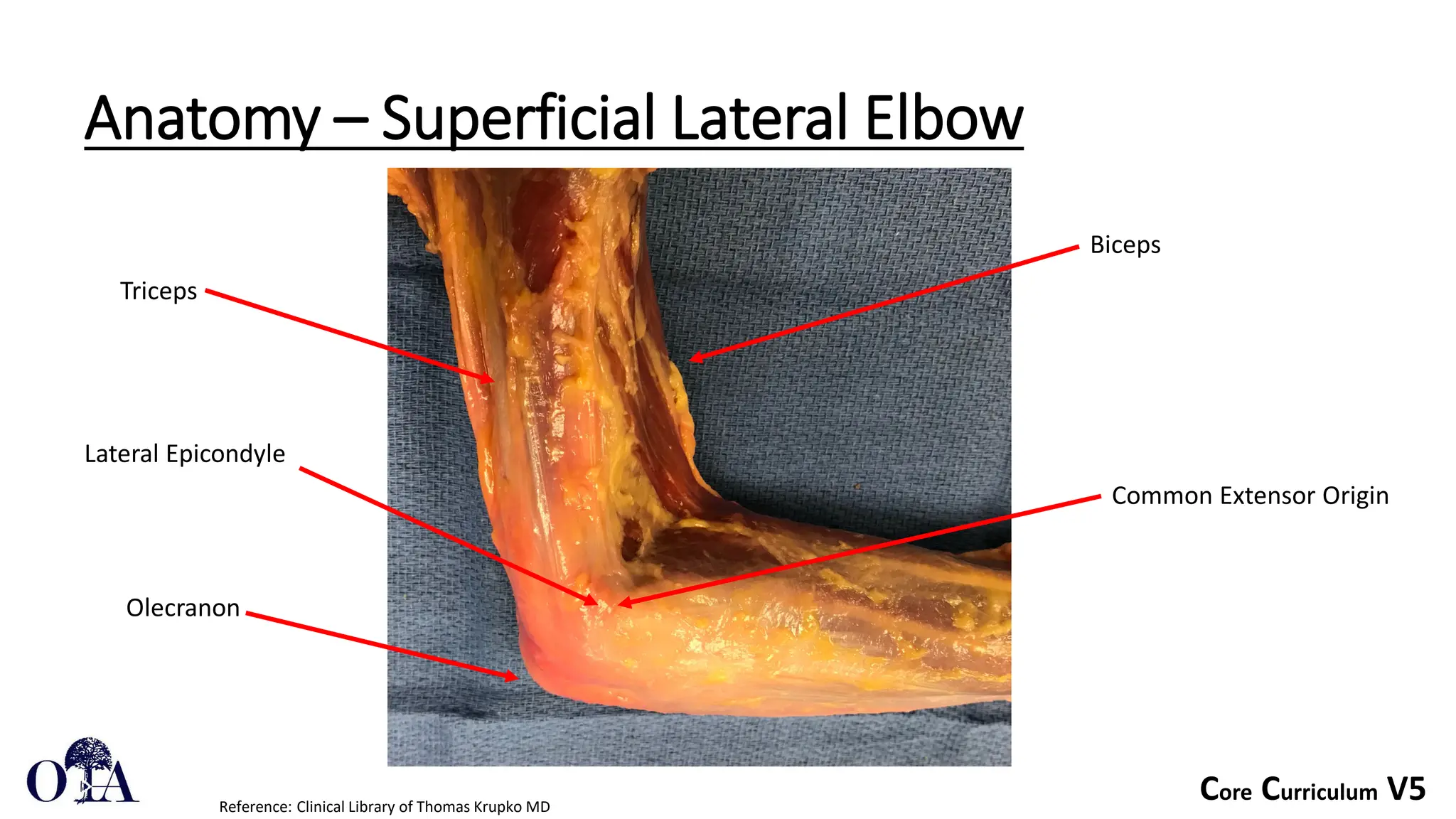 Core Curriculum V5
Anatomy – Superficial Lateral Elbow
Reference: Clinical Library of Thomas Krupko MD
Lateral Epicondyle
Triceps
Biceps
Olecranon
Common Extensor Origin
 