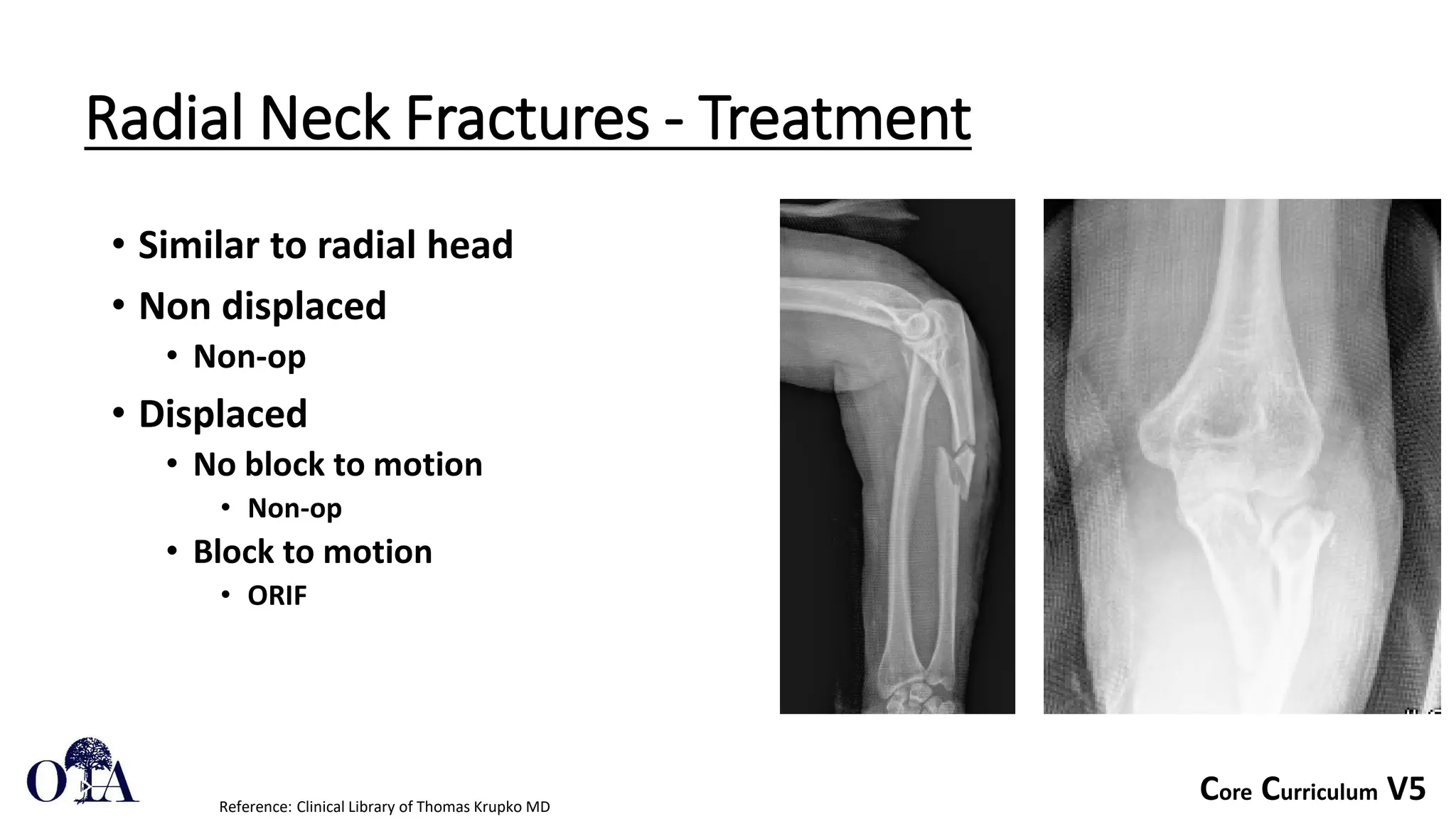 Core Curriculum V5
Radial Neck Fractures - Treatment
• Similar to radial head
• Non displaced
• Non-op
• Displaced
• No block to motion
• Non-op
• Block to motion
• ORIF
Reference: Clinical Library of Thomas Krupko MD
 