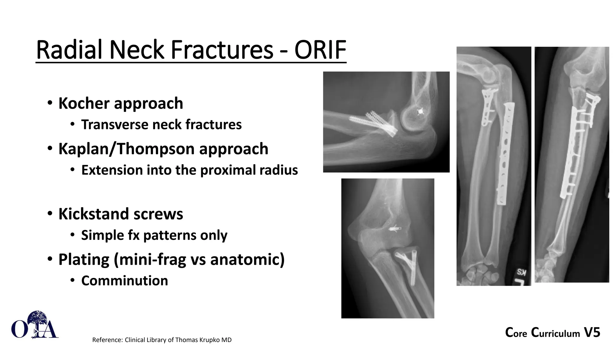 Core Curriculum V5
Radial Neck Fractures - ORIF
• Kocher approach
• Transverse neck fractures
• Kaplan/Thompson approach
• Extension into the proximal radius
• Kickstand screws
• Simple fx patterns only
• Plating (mini-frag vs anatomic)
• Comminution
Reference: Clinical Library of Thomas Krupko MD
 