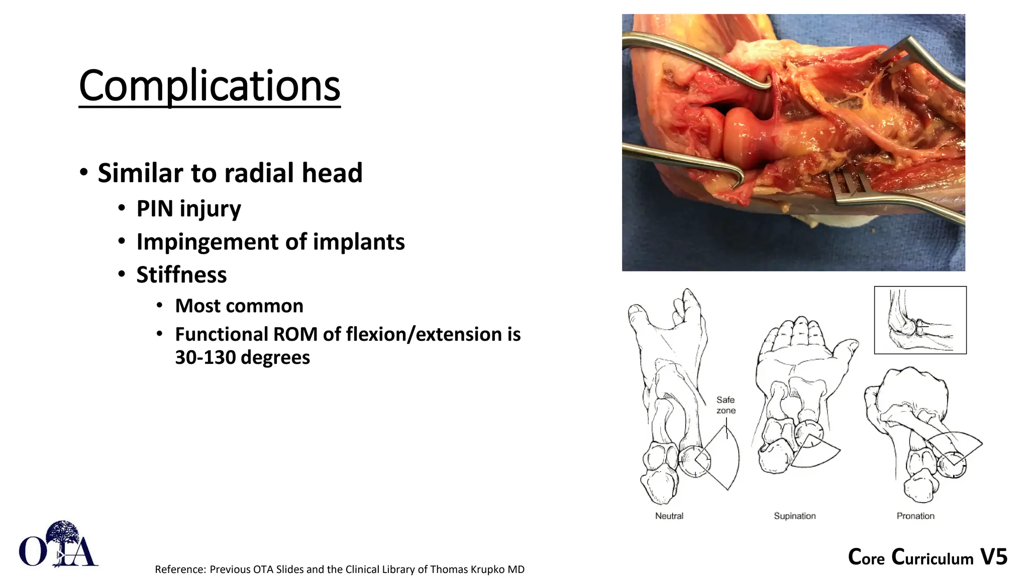 Core Curriculum V5
Complications
• Similar to radial head
• PIN injury
• Impingement of implants
• Stiffness
• Most common
• Functional ROM of flexion/extension is
30-130 degrees
Reference: Previous OTA Slides and the Clinical Library of Thomas Krupko MD
 