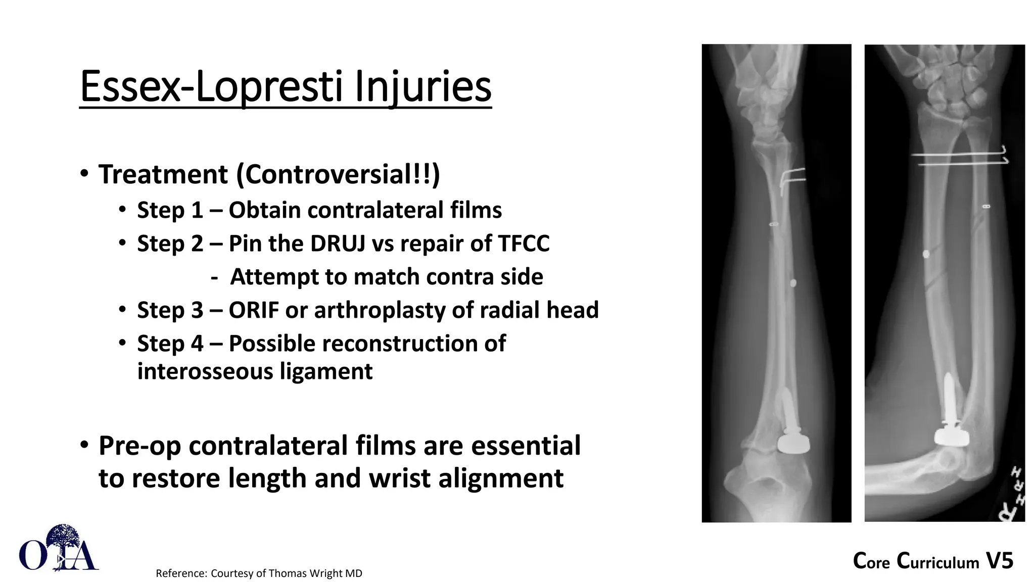 Core Curriculum V5
Essex-Lopresti Injuries
Reference: Courtesy of Thomas Wright MD
• Treatment (Controversial!!)
• Step 1 – Obtain contralateral films
• Step 2 – Pin the DRUJ vs repair of TFCC
- Attempt to match contra side
• Step 3 – ORIF or arthroplasty of radial head
• Step 4 – Possible reconstruction of
interosseous ligament
• Pre-op contralateral films are essential
to restore length and wrist alignment
 