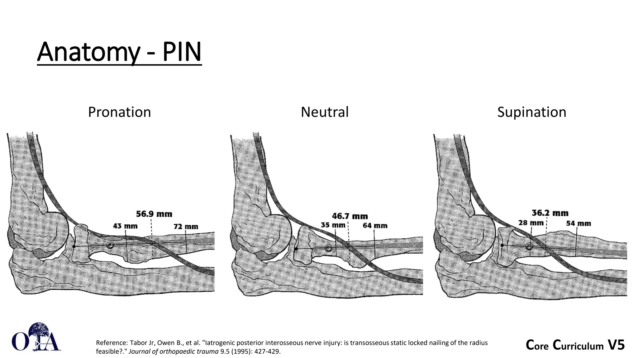 Core Curriculum V5
Anatomy - PIN
Pronation Supination
Neutral
Reference: Tabor Jr, Owen B., et al. "Iatrogenic posterior interosseous nerve injury: is transosseous static locked nailing of the radius
feasible?." Journal of orthopaedic trauma 9.5 (1995): 427-429.
 