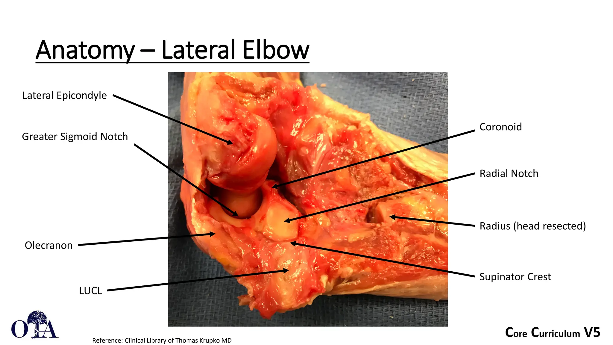 Core Curriculum V5
Anatomy – Lateral Elbow
Reference: Clinical Library of Thomas Krupko MD
Lateral Epicondyle
Supinator Crest
Coronoid
Greater Sigmoid Notch
Olecranon
Radial Notch
Radius (head resected)
LUCL
 