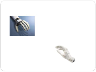 Rehabilitation of Upper Limb Amputee | PPTX