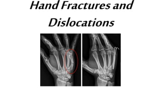 HandFracturesand
Dislocations
 