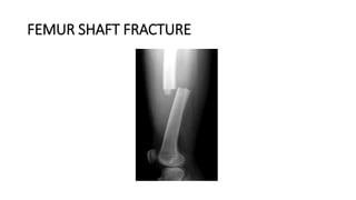 FEMUR SHAFT FRACTURE
 