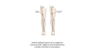 (Left) An oblique fracture has an angled line
across the shaft. (Right) A comminuted fracture
is broken into three or more pieces.
 