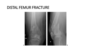 DISTAL FEMUR FRACTURE
 