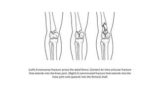 (Left) A transverse fracture across the distal femur. (Center) An intra-articular fracture
that extends into the knee joint. (Right) A comminuted fracture that extends into the
knee joint and upwards into the femoral shaft
 