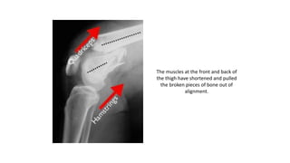 The muscles at the front and back of
the thigh have shortened and pulled
the broken pieces of bone out of
alignment.
 