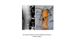 An external fixator is used to stabilize the fracture
before surgery.
 