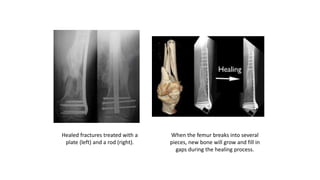 Healed fractures treated with a
plate (left) and a rod (right).
When the femur breaks into several
pieces, new bone will grow and fill in
gaps during the healing process.
 