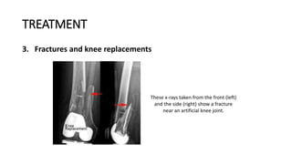 TREATMENT
3. Fractures and knee replacements
These x-rays taken from the front (left)
and the side (right) show a fracture
near an artificial knee joint.
 