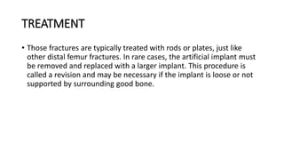 TREATMENT
• Those fractures are typically treated with rods or plates, just like
other distal femur fractures. In rare cases, the artificial implant must
be removed and replaced with a larger implant. This procedure is
called a revision and may be necessary if the implant is loose or not
supported by surrounding good bone.
 