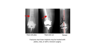 Fractures near knee implants may be treated with
plates, rods, or with a revision surgery.
 