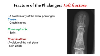 Fracture of the Phalanges: Tuftfracture
• A break in any of the distal phalanges
Cause:
- Crush injuries
Non-surgical tx:
- Splint
Complications:
-Avulsion of the nail plate
- Non union
 