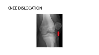 KNEE DISLOCATION
 