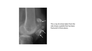 This x-ray of a knee taken from the
side shows a patella that has been
fractured in three places.
 
